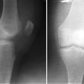 Pdf Osteochondral Fracture Of Patella