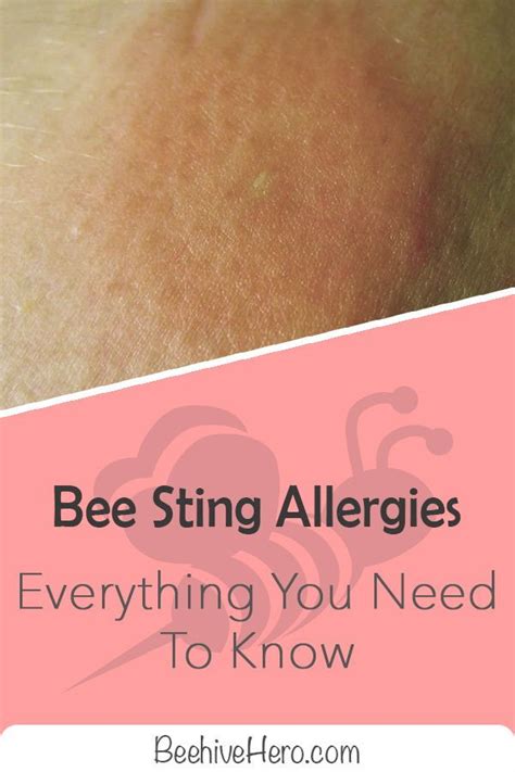 Whether Youre Allergic Or Not Understanding Bee Sting Reactions Can