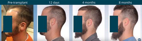 Hair Transplant Growth Chart Hair Transplant Recovery