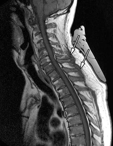 Spinal Changes In Patients With Spondyloarthritis Comparison Of Mr