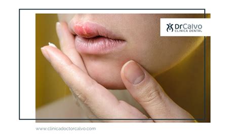 Herpes labial síntomas causas y tratamiento Clínica Doctor Calvo