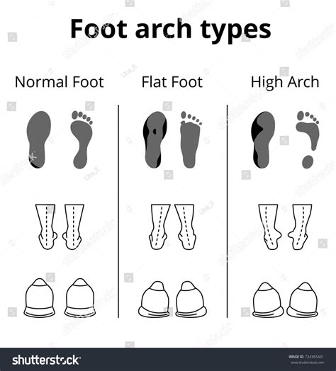 Foot Arch Types Vector Icons Set Stock Vector (Royalty Free) 734365441 ...