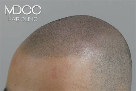 Dermopigmentation Cheveux Paris Micropigmentation Cheveux Paris