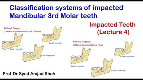 Classification System Of Impacted Mandibular 3rd Molar Pell And Gregory