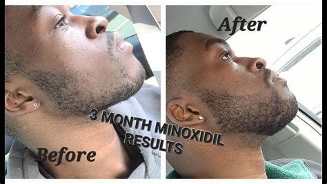 3 Month Minoxidil Beard Growth Results Tips And Tricks To Speed Up