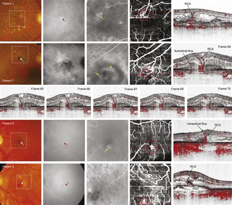 Phase Resolved Doppler Optical Coherence Tomographic Features In