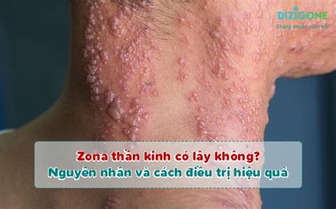 Zona thần kinh có lây không Giải mã nguyên nhân gây bệnh để điều trị