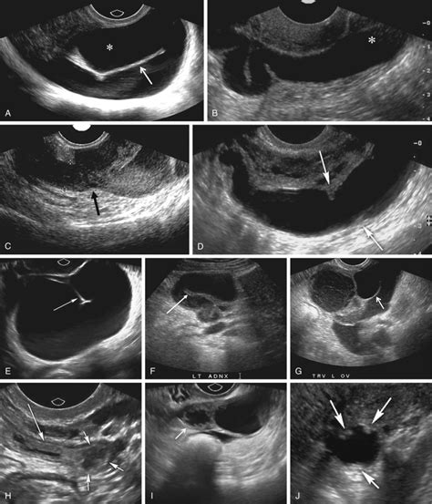 Ultrasound Evaluation Of The Fallopian Tube Radiology Key