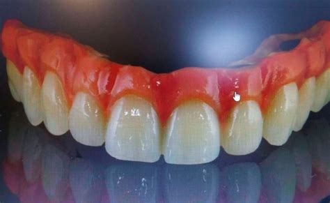 Composite Dental Qu Es Y Para Qu Sirve