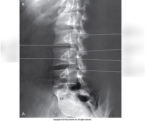 Figure A A Ap Oblique Lumbar Spine Rpo For Right Zygapophyseal