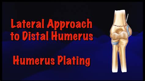 Lateral Approach To Distal Humerus Humerus Plating Surgical Technique Dr Deepak Garg Youtube