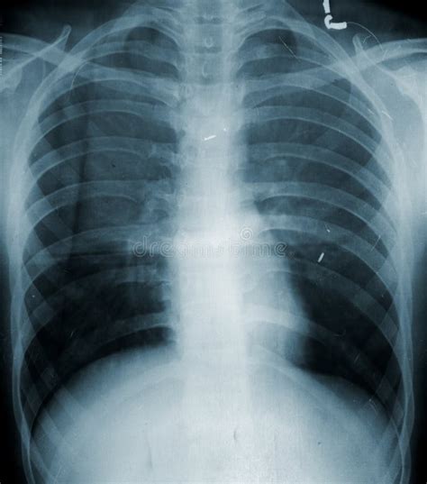 Chest Xray Stock Image Image Of Diagnosis Chest Illness 18513447