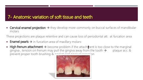 Local Predisposing Factor Of Periodontal Disease