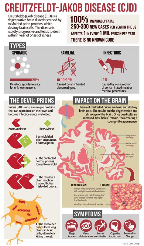 Creutzfeldt-Jakob Disease – DC