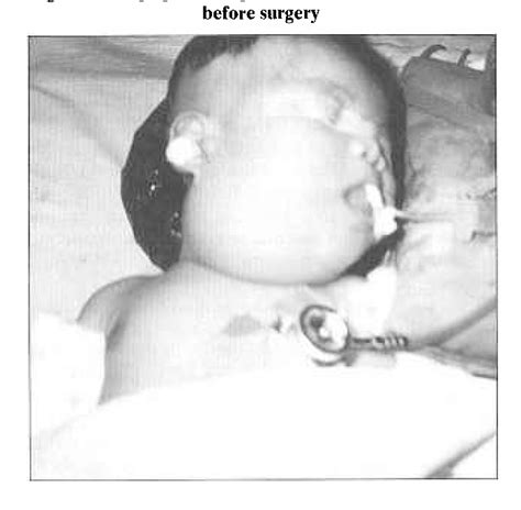 Figure 1 From Cystic Hygroma Anaesthetic Considerations And Review Semantic Scholar