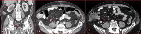 Diversion Ahead Imaging Appearance Of Urinary Diversions And