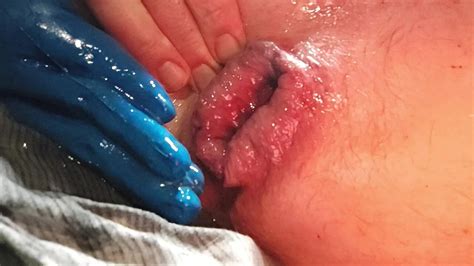 Anal Gape Gay Fisting Fisting Porn Feat Anal Fixiert XHamster