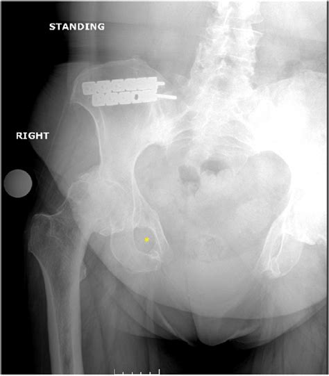 For Preoperative Planning A Standing Anteroposterior Radiograph Is Download Scientific Diagram