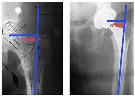 Jcm Free Full Text Effect Of Total Hip Arthroplasty With Ceramic Acetabular Component On