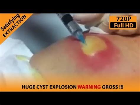 Removing A Very Huge Cyst From Lower Back Warning Gross