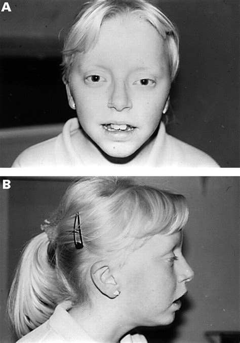 Clinical and molecular findings in a patient with a deletion on the ...