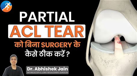 Partial Acl Tear का इलाज Treatment Of Partial Acl Tear Without Surgery In Hindi Acl Tear