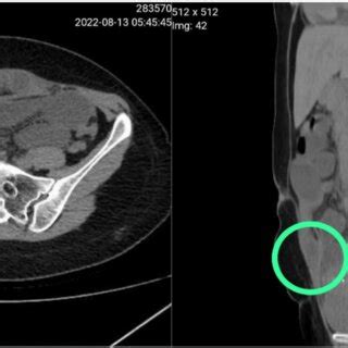 Computed tomography scan showing posterior rectus sheath hernia ...