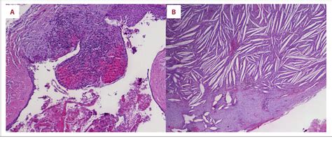 Figure 2 From Bilateral Mandibular Dentigerous Cysts Presenting As An Incidental Finding A Case