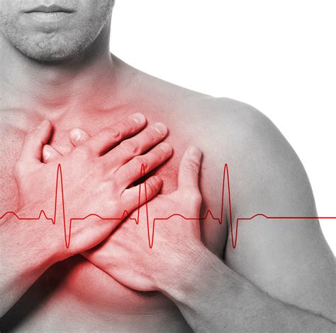 Síndrome de Brugada Cardiopatias Familiares