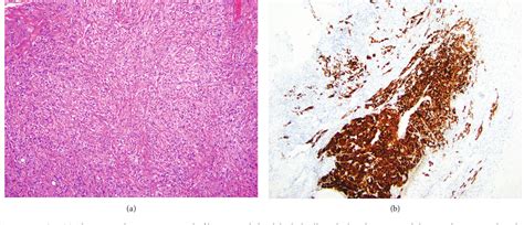 Figure 1 From Varying Phenotypes Of Leydig Cell Hyperplasia Of The