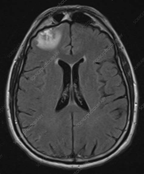 Brain Contusion, MRI - Stock Image - C039/3521 - Science Photo Library