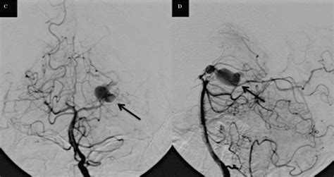 Figure 1 From Endovascular Treatment Of A Giant Dissecting Aneurysm Of