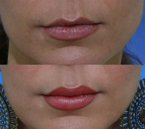 Lip Lines At Castleknock Cosmetic Clinic Dublin Castleknock Cosmetic