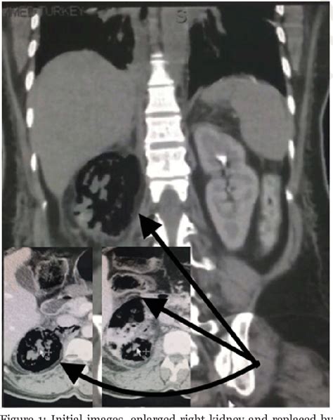 Figure 1 From Emphysematous Pyelonephritis Treated Successfully With Conservative Management A