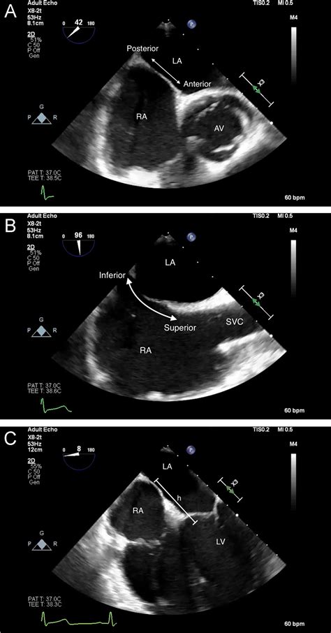 The Mitraclip Procedurea Comprehensive Review For The Cardiac