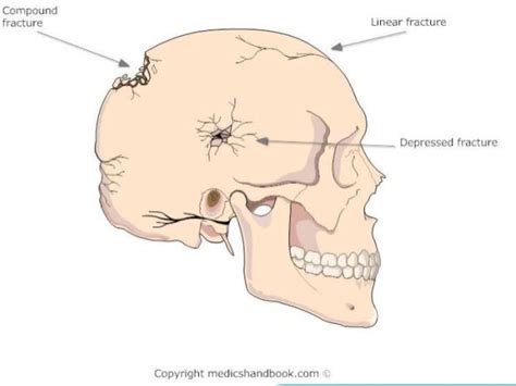 Craniocerebral Trauma 1