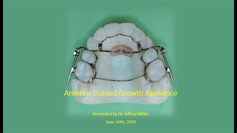 Anterior Guided Growth Appliance Agga Is It Safe No Youtube