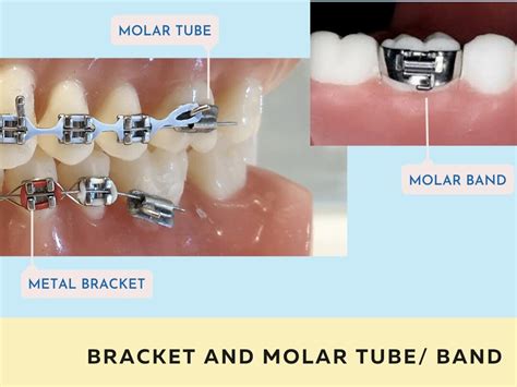 Align Braces Clinic Singapore Orthodontist And Dentist Invisalign