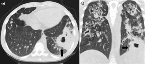 Ultra Low Dose Computed Tomography Using Model Based Iterative