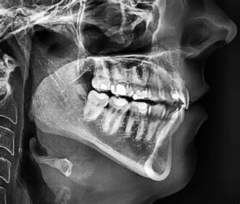 Lateral Cephalometric Radiograph Showing A Patient Presenting A