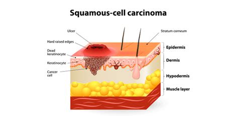 Squamous Cell Carcinoma Skin Histology