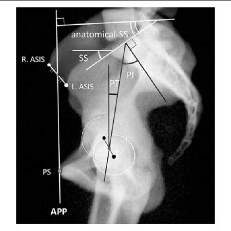 Measurements Of Spinopelvic And Spinal Parameters In 144 Healthy