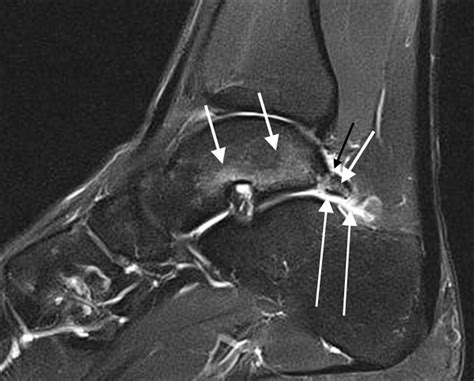 Posterior Ankle Impingement In Athletes Pathogenesis Imaging Features