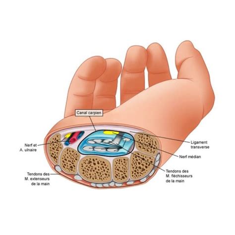 Syndrome Du Canal Carpien Pro Tms