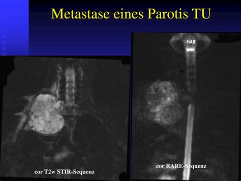 PPT MRT bei Plexus brachialis Läsionen PowerPoint Presentation free