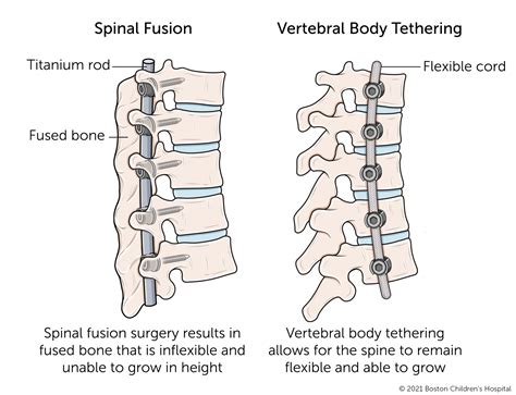 Vertebral Body Tethering | Boston Children's Hospital