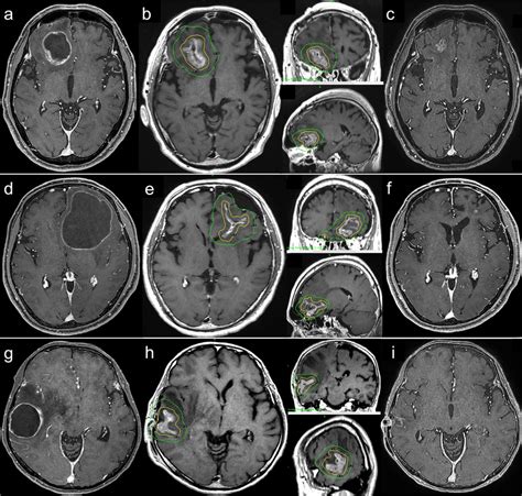 A Axial Contrast Enhanced T Weighted Magnetic Resonance Imaging