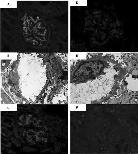 Immunofluorescent And Electron Microscope Findings First A C