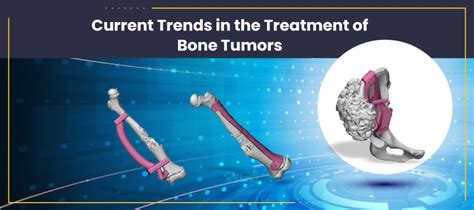 Current Trends In the Treatment of Bone Tumours | 3DIncredible