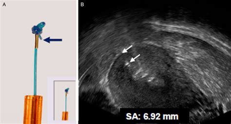 New Visualised Anchor For Frameless Iud Is Helpful For Checking Correct